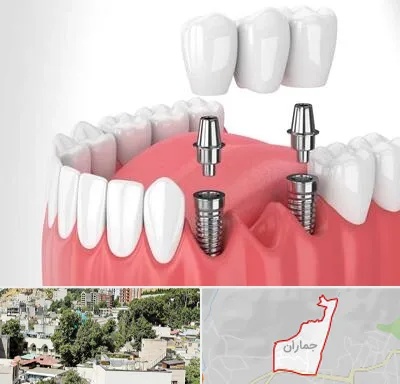 کاشت دندان در جماران