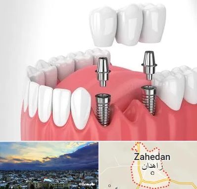 کاشت دندان در زاهدان