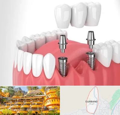 کاشت دندان در دربند