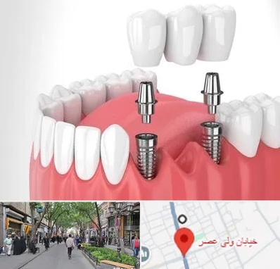 کاشت دندان در ولیعصر شهریار