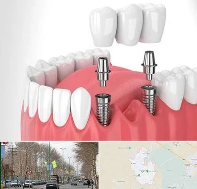 کاشت دندان در نظرآباد کرج