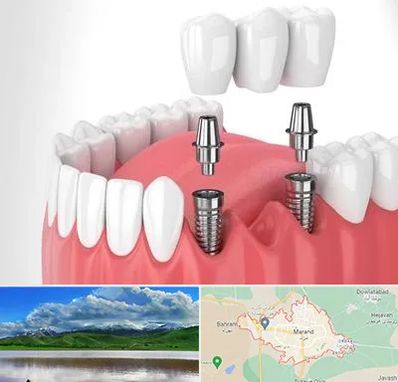 کاشت دندان در مرند