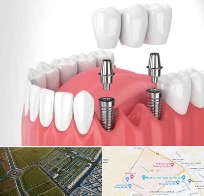 کاشت دندان در الهیه مشهد