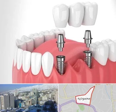 کاشت دندان در محمودیه