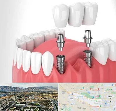 کاشت دندان در منطقه 21 تهران