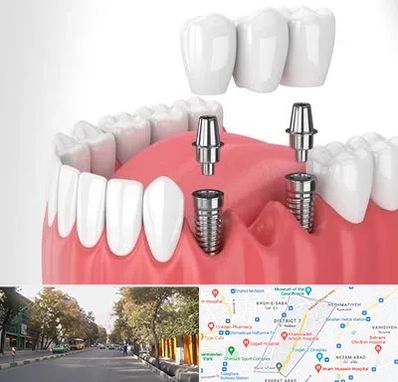 کاشت دندان در شریعتی 