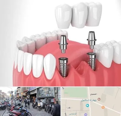 کاشت دندان در چهارراه استانبول