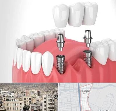 کاشت دندان در اسکندری
