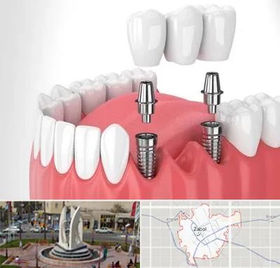 کاشت دندان در زابل