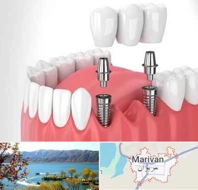 کاشت دندان در مریوان