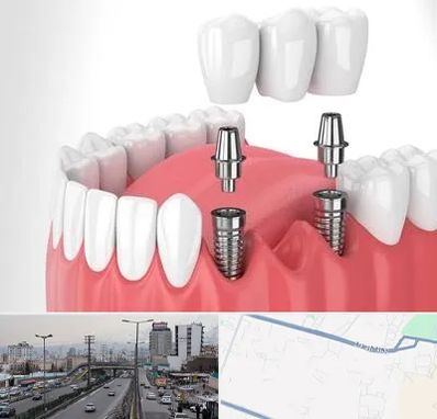 کاشت دندان در بلوار ارتش