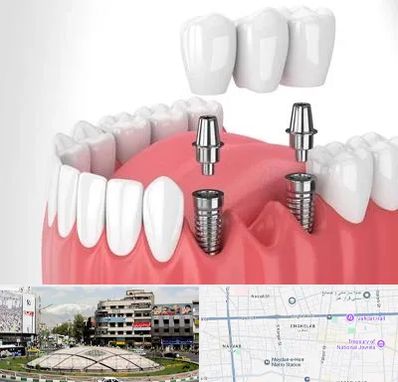 کاشت دندان در مرکز تهران