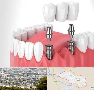 کاشت دندان در یاسوج