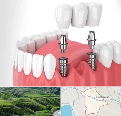 کاشت دندان در گچساران