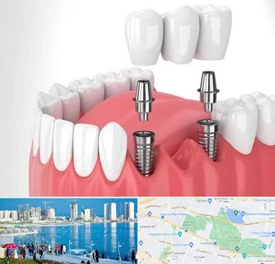 کاشت دندان در چیتگر 