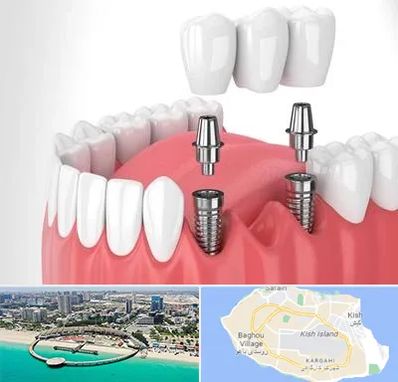 کاشت دندان در کیش