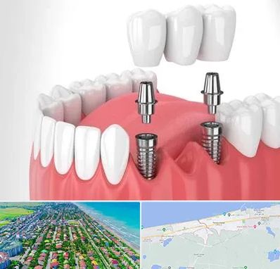 کاشت دندان در فریدونکنار