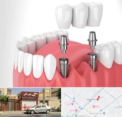 کاشت دندان در باجک قم