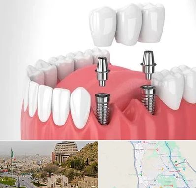 کاشت دندان در فرهنگ شهر شیراز