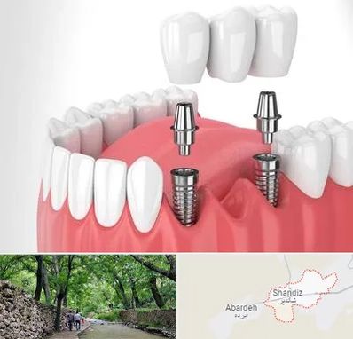 کاشت دندان در شاندیز مشهد