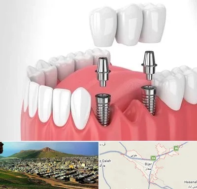 کاشت دندان در بیجار