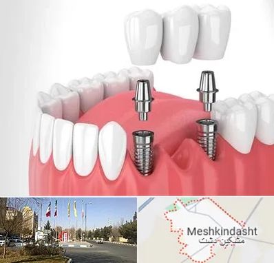 کاشت دندان در مشکین دشت