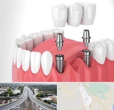 کاشت دندان در اندیمشک