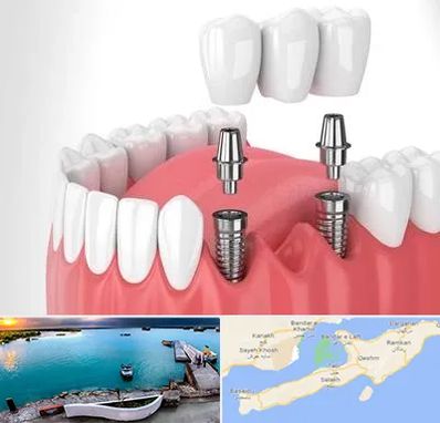 کاشت دندان در قشم