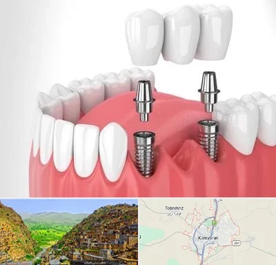 کاشت دندان در کامیاران