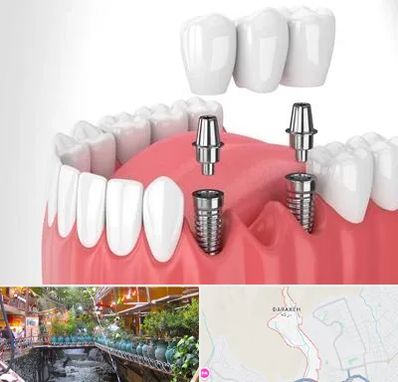کاشت دندان در درکه