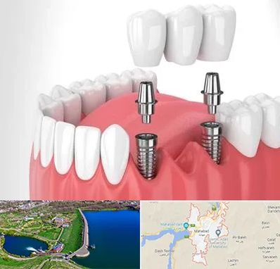کاشت دندان در مهاباد