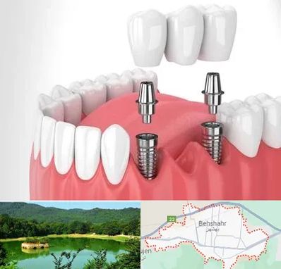 کاشت دندان در بهشهر