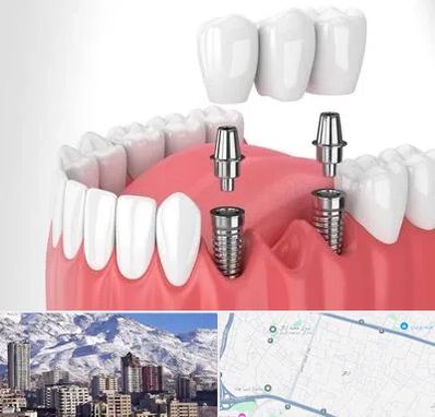 کاشت دندان در ازگل