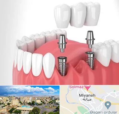 کاشت دندان در میانه