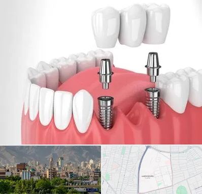 کاشت دندان در جمشیدیه