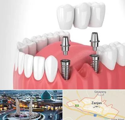 کاشت دندان در زنجان