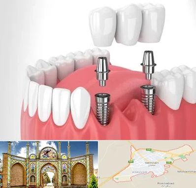کاشت دندان در سمنان