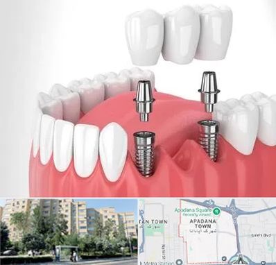 کاشت دندان در آپادانا