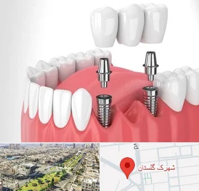 کاشت دندان در شهرک گلستان