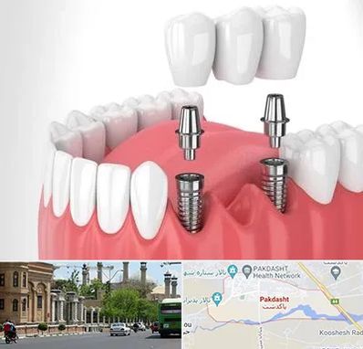 کاشت دندان در پاکدشت