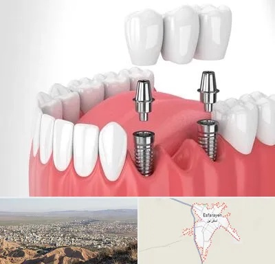 کاشت دندان در اسفراین
