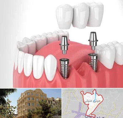 کاشت دندان در مینی سیتی