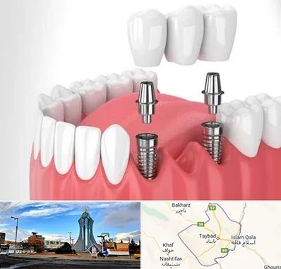 کاشت دندان در تایباد