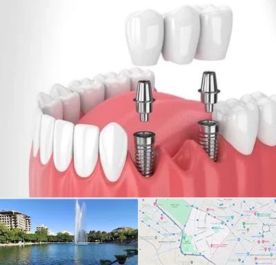 کاشت دندان در کوهسنگی مشهد