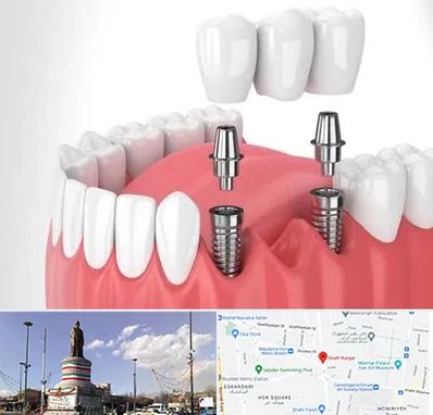 کاشت دندان در کارگر جنوبی