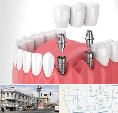 کاشت دندان در 17شهریور