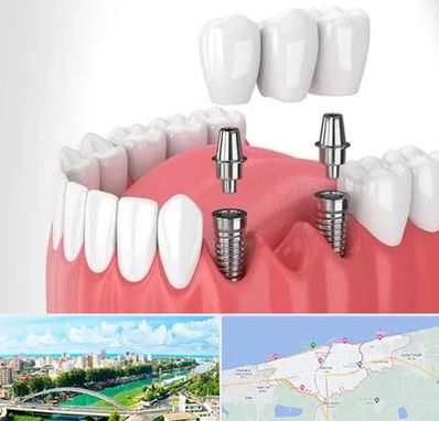 کاشت دندان در بابلسر