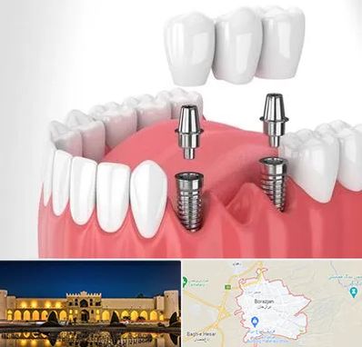 کاشت دندان در برازجان