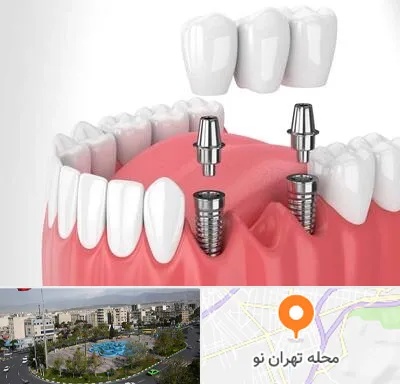 کاشت دندان در تهران نو