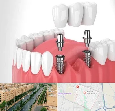 کاشت دندان در فاز سه اندیشه